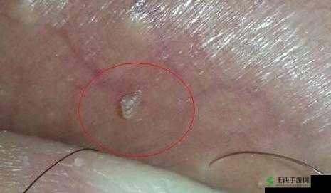 睾丸进入子宫的里面长肉粒是怎么回事？