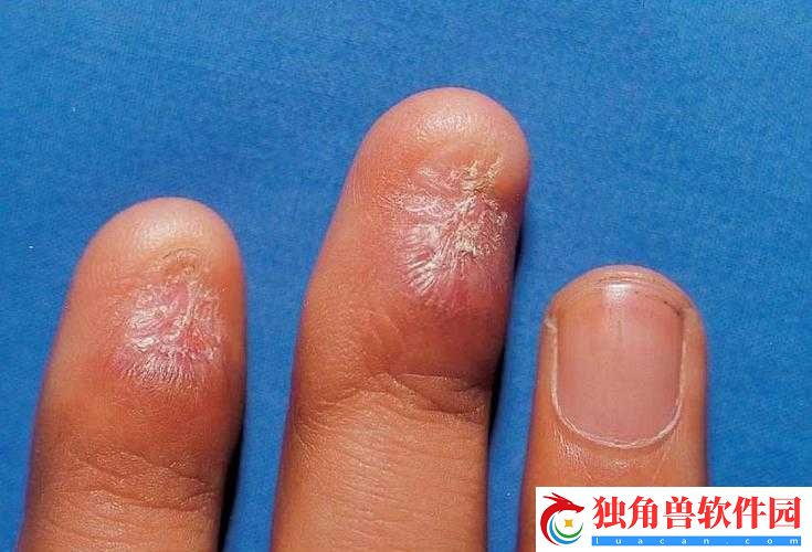 获得超级胬肉系统：踏上巅峰之路